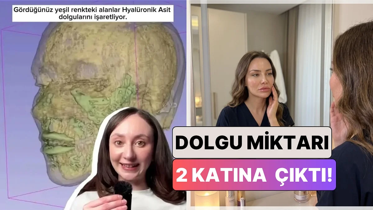 Bir İçerik Üreticisi 33 Yaşındaki Kadının Yüzündeki Dolguların Zamanla Geldiği Hali MR Görüntüleriyle Gösterdi