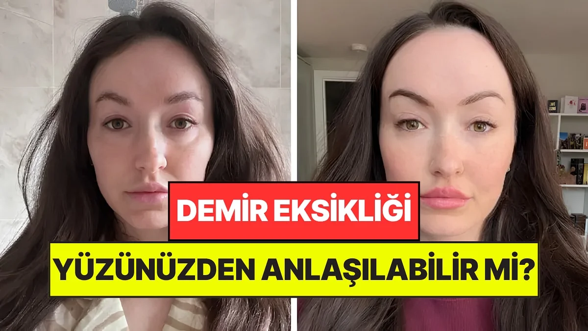 Demir Eksikliği Dış Görünüşünüzden Anlaşılabilir mi? Yeni Akım Çok Konuşuldu
