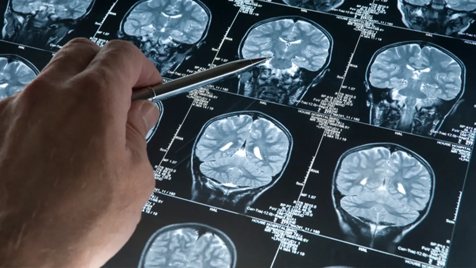 Alzheimer hastalığında yeni gelişme! Beyindeki damarları korumak mümkün olabilir